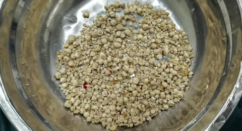 330余颗！大大小小的结石装了一盆！