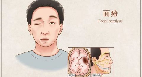 春风拂面，有人嘴被“吹”歪了