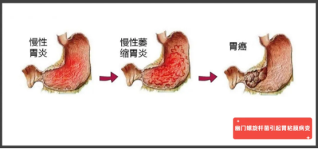 14岁少年反复溃疡、贫血，问题竟在......