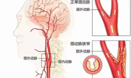 严重可致中风！评估血管斑块，用这个方法判断最便捷→