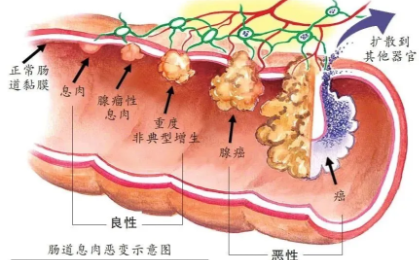 息肉变肠癌，这项检查很重要→
