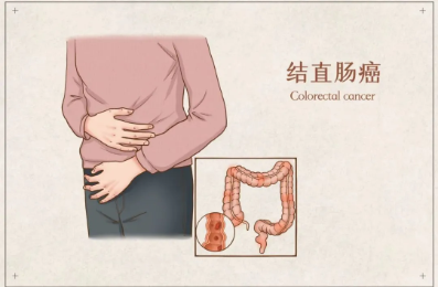 一查就是癌，肠道大扫雷，这项免费筛查别错过